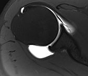 Perthes Lesion MRI 3